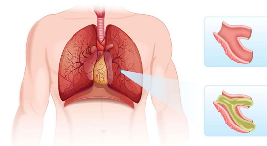 ● Inflammation of the bronchioles 

● Bronchioles 

○ Smallest branches of the airway 

○ Lead to alveoli 

● Alveoli 

○ Air sacs 

○ Location of gas exchange in the lungs  

● Thick mucus clogs up the  bronchioles 

● Leads to decreased gas exchange  in alveoli 

○ Air trapping 

○ Collapsed alveoli 

● Most common in children under 2 years old 

● Seasonal illness 

○ Most common in winter 

● Causative agent usually viral 

○ Respiratory Syncytial Virus (RSV) 

● Very contagious 

● Worst on days 4-6