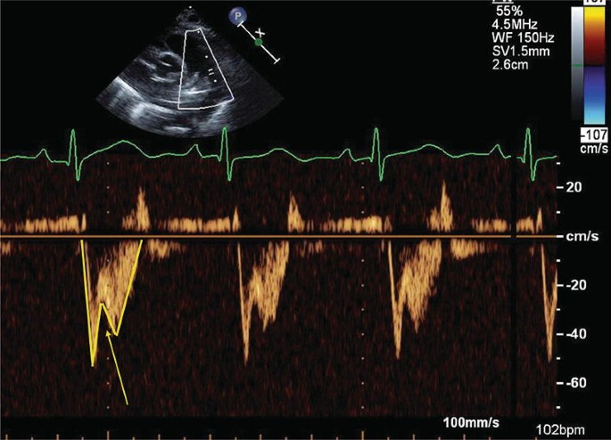 <p>Pulmonary HTN<br>Flying w sign</p>