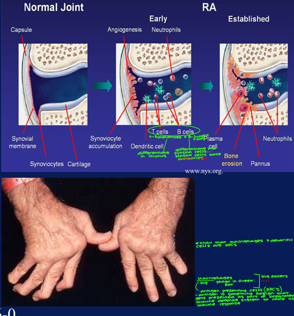 <ul><li><p>Rheumatoid arthritis (RA) is a <strong>long-term <em><u>autoimmune disorder **(antibody or Ig) 5 types/classes of Ig (M, A, D, E, & G)</u></em></strong> that primarily affects joints. It typically results in warm, swollen, and painful joints. Pain and stiffness often worsen following rest. Most commonly, <strong><em><u>the wrist and hands are involved</u></em></strong>, with the same joints typically involved on both sides of the body. <strong>NOTE- we have studied <em><u>dendritic cells</u></em> **<em><u>(antigen presenting cells)</u></em> before!</strong></p><ul><li><p>autoimmune: auto → self</p></li><li><p>antigens are foreign particles, Ig attaches to it, macrophages come in & devour whole thing </p></li></ul></li><li><p><strong>NOTE- **dendritic cells are typically found in high numbers within a tumor</strong></p></li><li><p>T cells (T-lymphocytes) & B cells (B-lymphocytes)</p><ul><li><p>T-lymphocytes differentiate in thymus </p></li><li><p>B-lymphocytes differentiate into plasma cells… plasma cells make antibodies </p></li></ul></li><li><p>Know that macrophages & dendritic cells are antigen presenting cells (APC’s)</p><ul><li><p>macrophages: macro → big </p></li><li><p>phages: phago in Greek → eat </p></li><li><p>^^ BIG EATERS </p></li><li><p>antigen is something foreign that gets presented as part of integrated immune defense system to ramp up immune response </p></li><li><p>dendritic cells oftentimes found in high #’s, found w/in heavy concentration in tumors </p></li></ul></li></ul><p></p>