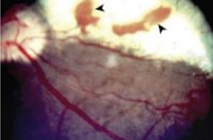 <p>What metabolic disease can also contribute to retinal degeneration?</p>