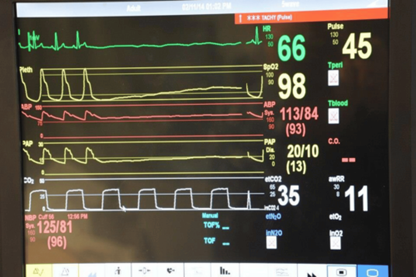 <p>Hemodynamic instability, ongoing chest pain, dynamic ECG changes, sustained ventricular arrhythmias, signs of heart failure</p>