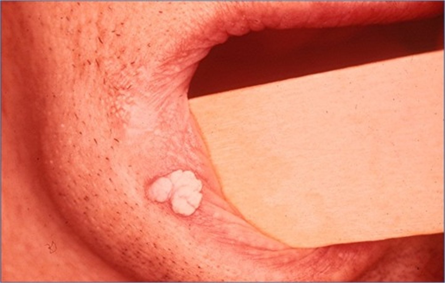 <p>excision and/or cryotherapy (benign)</p>