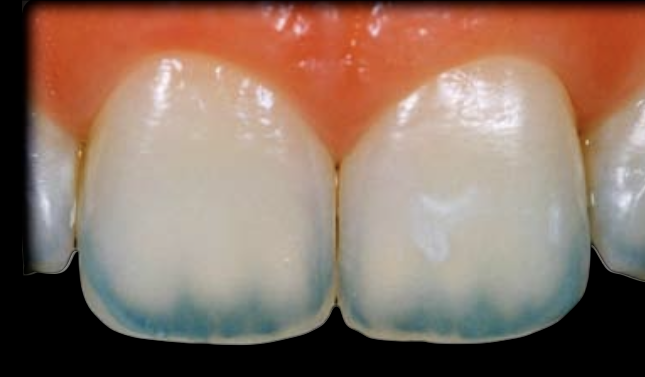 <p></p><ul><li><p>Type I Opalescent Layer features an incisal opalescence that closely related to the dentin mamelons.</p></li></ul><p>*53% of patients exhibit Type I Opalescent Layer.</p><ul><li><p>Type | Opalescent Layer is either continuous or intermittent, but it has an intimate relationship with the dentin mamelons.</p></li></ul><p></p>