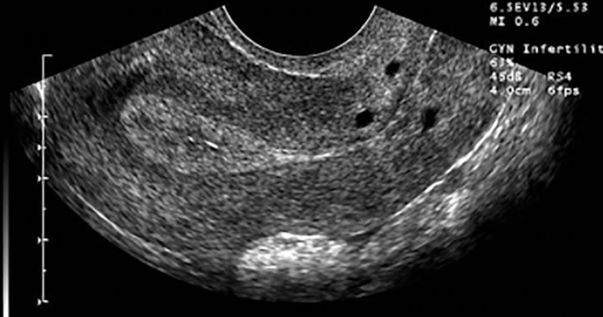 <p>• Benign cysts in the cervix which result from chronic cervicitis and are <strong><em>seen frequently in middle-aged women</em></strong>. This cyst results from an obstructed dilated transcervical gland and is also called an <strong><em>epithelial inclusion cyst</em></strong>.</p><p class="p1">• Chronic inflammatory retention cysts</p><p class="p1">• Asymptomatic although may cause pain/bleeding with coitus</p><p class="p2">• On <strong><em>sonographic evaluation include:</em></strong></p><p class="p1">• discrete</p><p class="p1">• round</p><p class="p1">• fluid-filled</p><p class="p1">• anechoic</p><p class="p1">• usually measuring less than 2 cm;</p><p class="p1">• they may be multiple.</p><p class="p2">• Occasionally, nabothian cysts may have <em>internal echoes </em>that may be caused by hemorrhage or infection.</p>