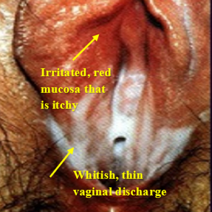 <p>caused by : Gardnerella vaginalis </p><ul><li><p>decrease in lactobacilli allows the bacteria to grow </p></li></ul><p>symptoms : </p><ul><li><p>grey white discarge </p></li><li><p>foul odor </p></li><li><p>due cells </p></li></ul><p>men - painful pee + pus </p><p>v-factors </p><ul><li><p>biofilms ‘</p></li><li><p>vaginolys’s ( membrane disrupting toxin ) </p></li><li><p>clue cells </p></li></ul><p></p>