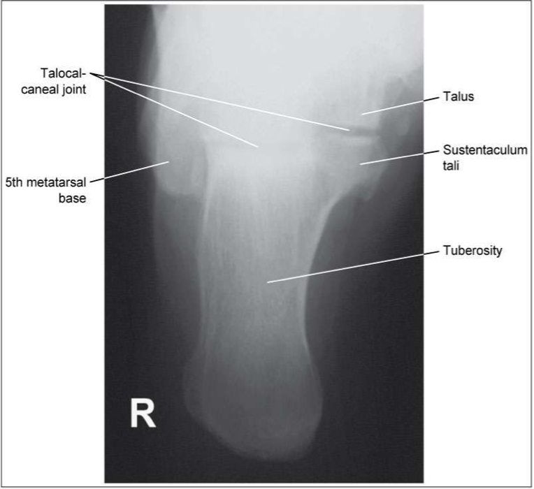 <p><span style="line-height: normal;"><span>• </span></span>Entire calcaneous visualized</p><p class="p1"><span style="line-height: normal;"><span>• </span></span>Including open talocalcaneal joint space</p><p class="p1"><span style="line-height: normal;"><span>• </span></span>No rotation</p><p class="p1"><span style="line-height: normal;"><span>• </span></span>Base of the 5<span style="line-height: normal;"><span>th</span></span> MT seen laterally</p><p class="p1"><span style="line-height: normal;"><span>• </span></span>Sustentaculum tali visible in profile medially</p>