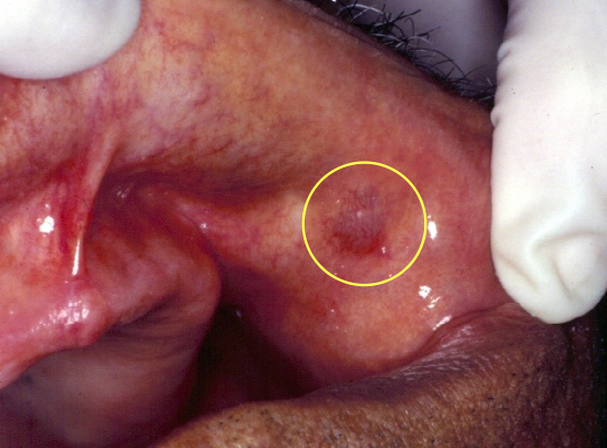 <p>What is a salivary duct cyst?</p>