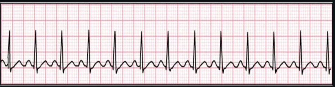 <p>ECG Interpretation</p>