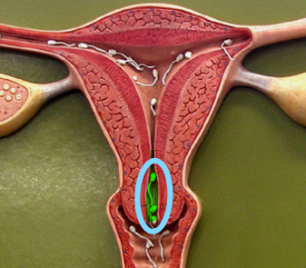 <p>Cervical canal</p>