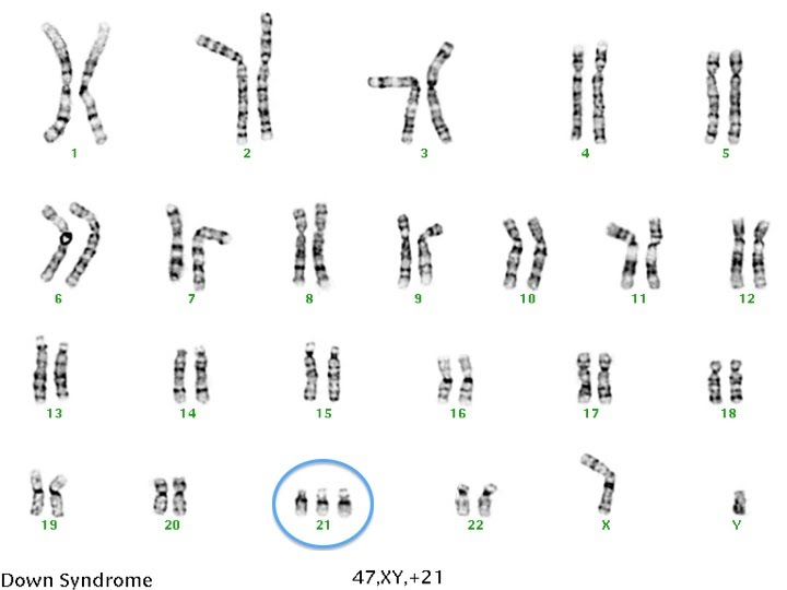 <p>If a gamete with an extra chromosome is fertilised by a normal gamete, the zygote will show trisomy (three chromosome copies, instead of two) → e.g. Down’s syndrome (caused by trisomy 21)</p>