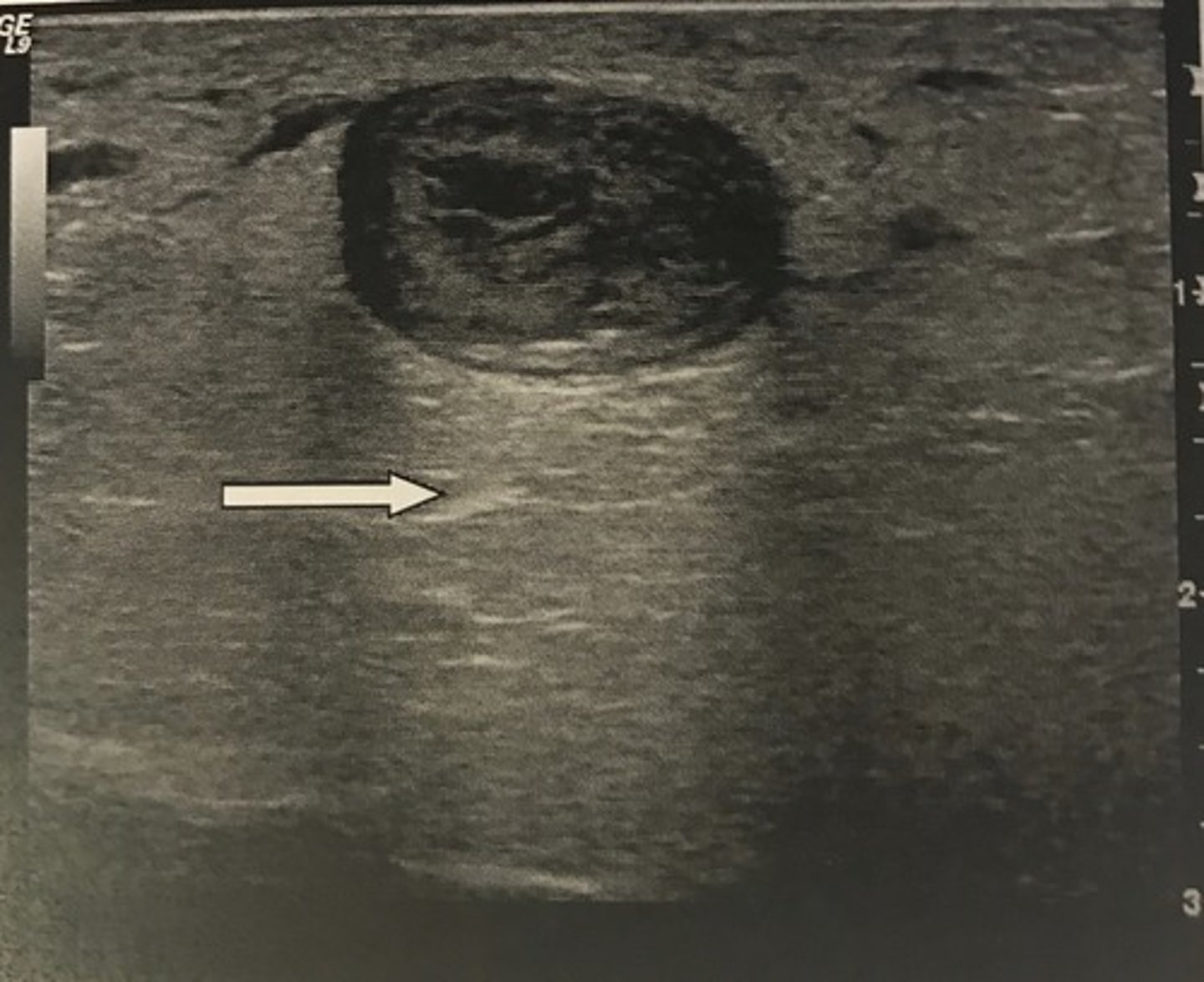 <p>Acoustic enhancement</p><p>Enhancement is caused by a lower attenuation within the structure than in the surrounding tissue.</p>