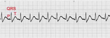 Contains 1 P wave for every QRS complex