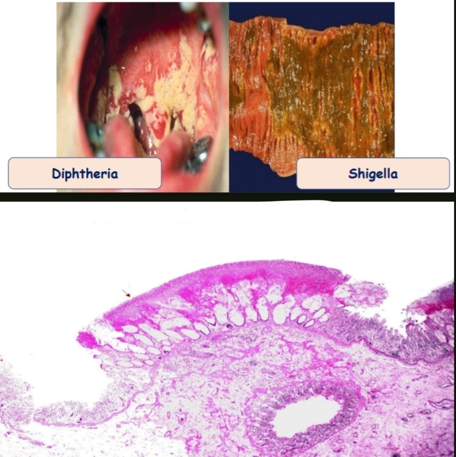 <p>pseudomembranous inflammation(adherent false membrane).</p><p>The membrane is formed of necrotic mucosa + fibrin + inflammatory exudate.</p><p>1-Diphtheria</p><p>2-Shigella.</p>