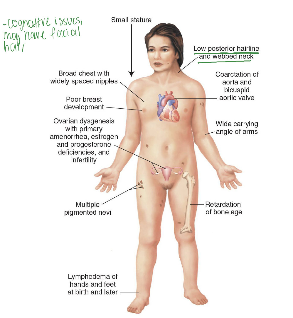 <p>45, XO Karyotype. May result in spontaneous abortion. Variations in disease severity.</p><p>Effects women. Missing X, estrogen deficiency. Cognitive issues, may have facial hair</p>