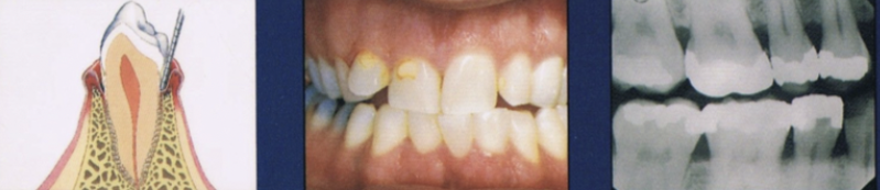 <ul><li><p>Progression of gingival inflammation into deeper periodontal structures and alveolar bone crest</p></li><li><p><strong>Slight bone loss</strong></p></li><li><p>Slight loss of CT attachment + alveolar bone</p></li></ul><p></p>