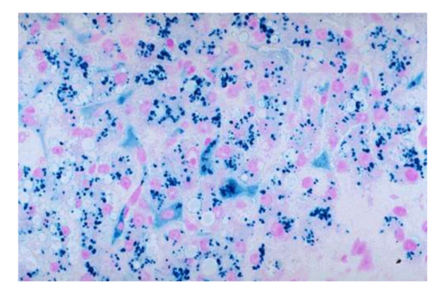 <p>Identifies yellow-brown granules of hemosiderin in cells and casts</p>