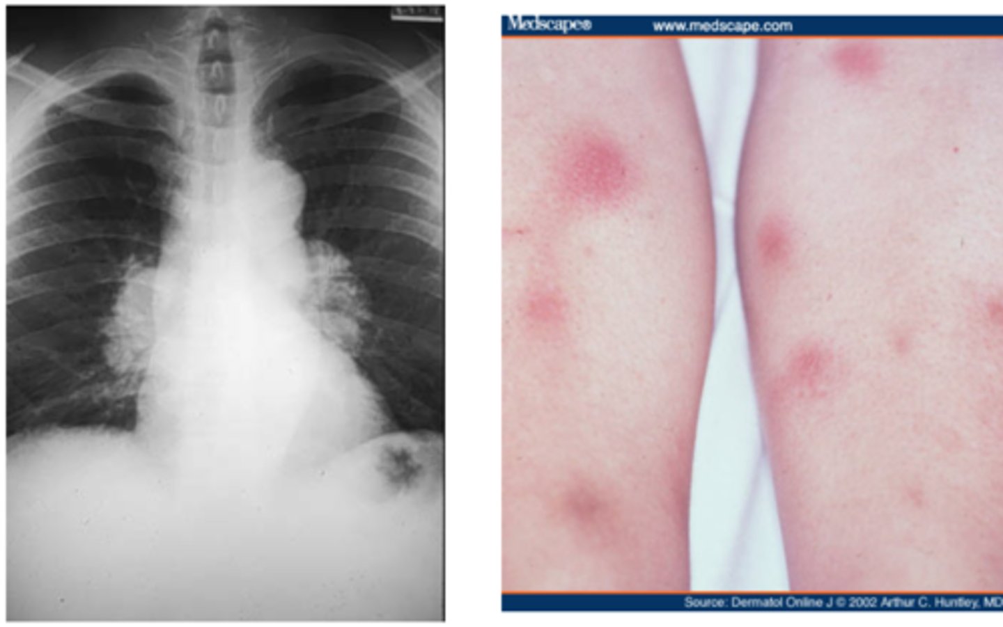 <p>sarcoidosis <br>-lupus pernio: plaques on nose, cheeks, ears---&gt; worse prognosis if patient has this <br><br>-E. nodosum: red nodules on the anterior legs --&gt; better prognosis than patients with lupus pernio</p>