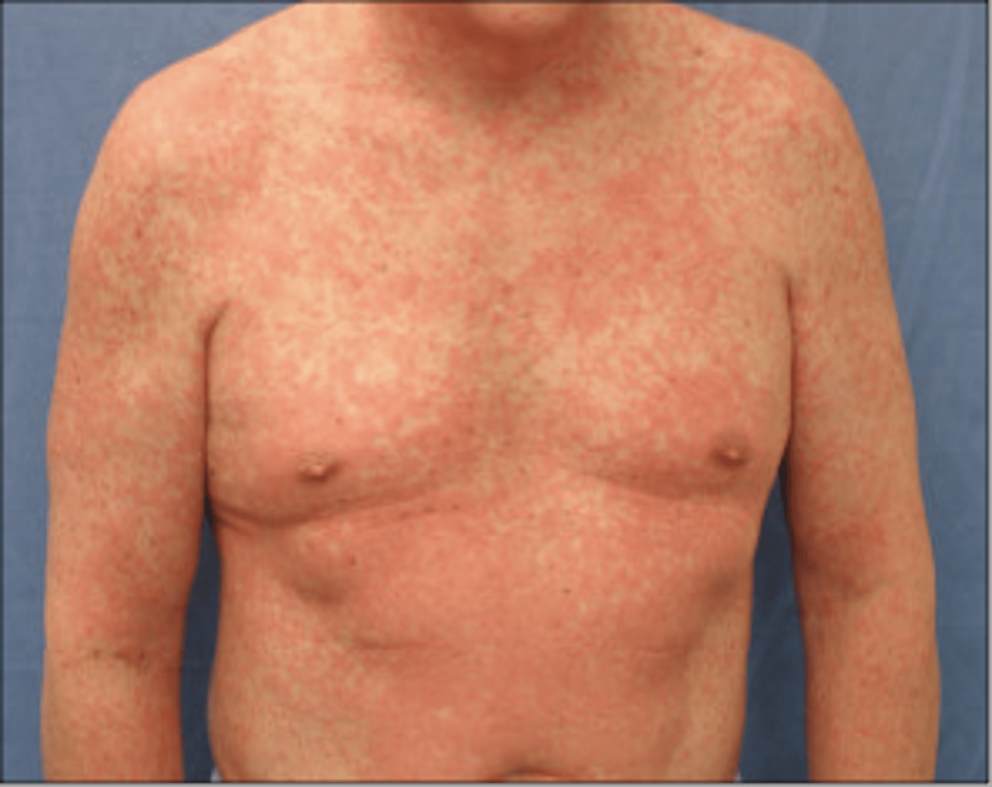 <p>Exanthematous, morbilliform rashes</p>