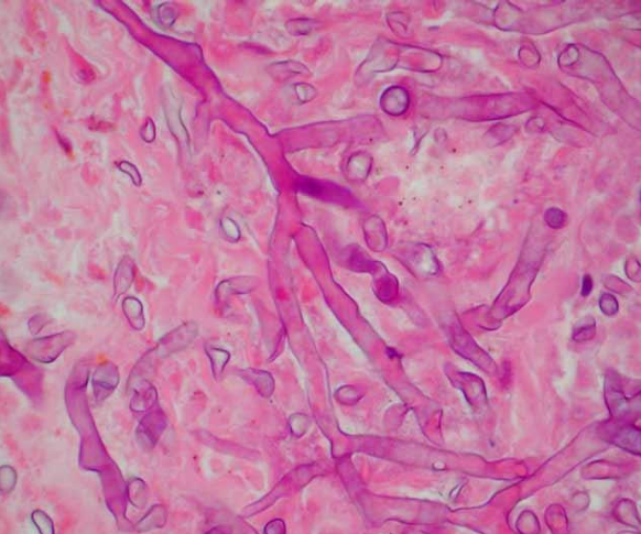 <p>-highly-aggressive opportunistic fungal infection that occurs under conditions of acidosis, hyperglycemia, and iron overload- mortality is greater than 40%</p><p>-caused by molds in the order Mucorales (Rhizopus, Mucor, Rhizomucor, Cunninghamella, Absidia)</p><p>-on histology, appear as thick-walled, ribbon-like, irregular, aseptate hyphae with branches at 90-degree angles</p>