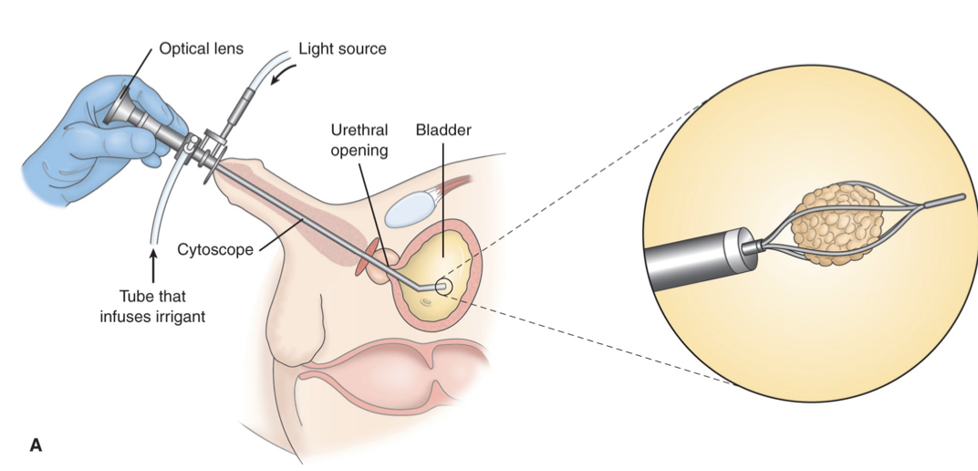 <p></p><ul><li><p>Visualizing the stone then destroying it</p></li><li><p>Access to the stone via ureteroscope into the ureter then inserting a lazer or ultrasound device to remove stone</p></li><li><p>Stent may be put in place to keep the ureter patent</p></li></ul>