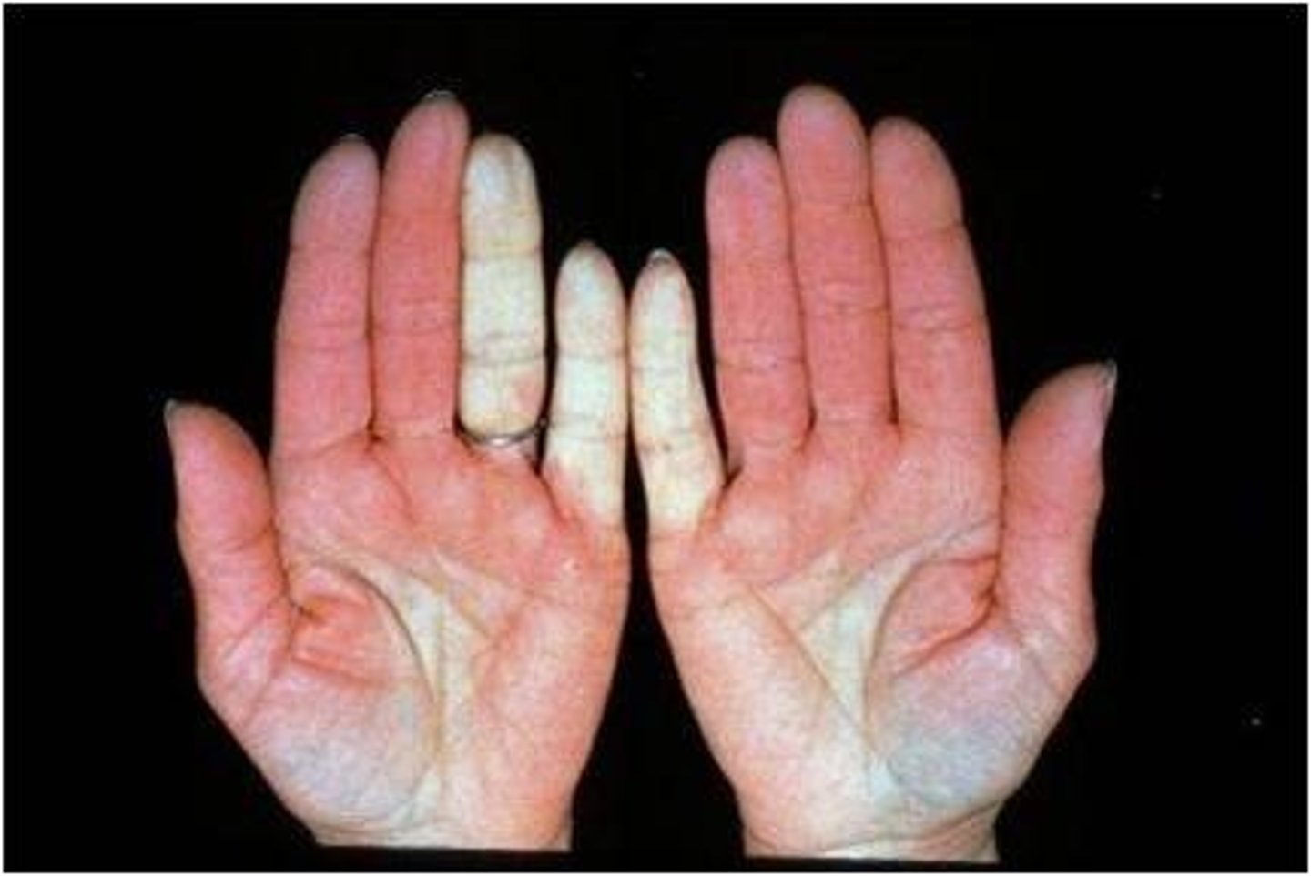 <p>Raynaud phenomenon (vasospasm in extremities)</p>
