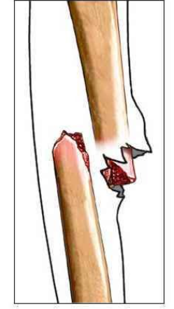 Displaced fracture
