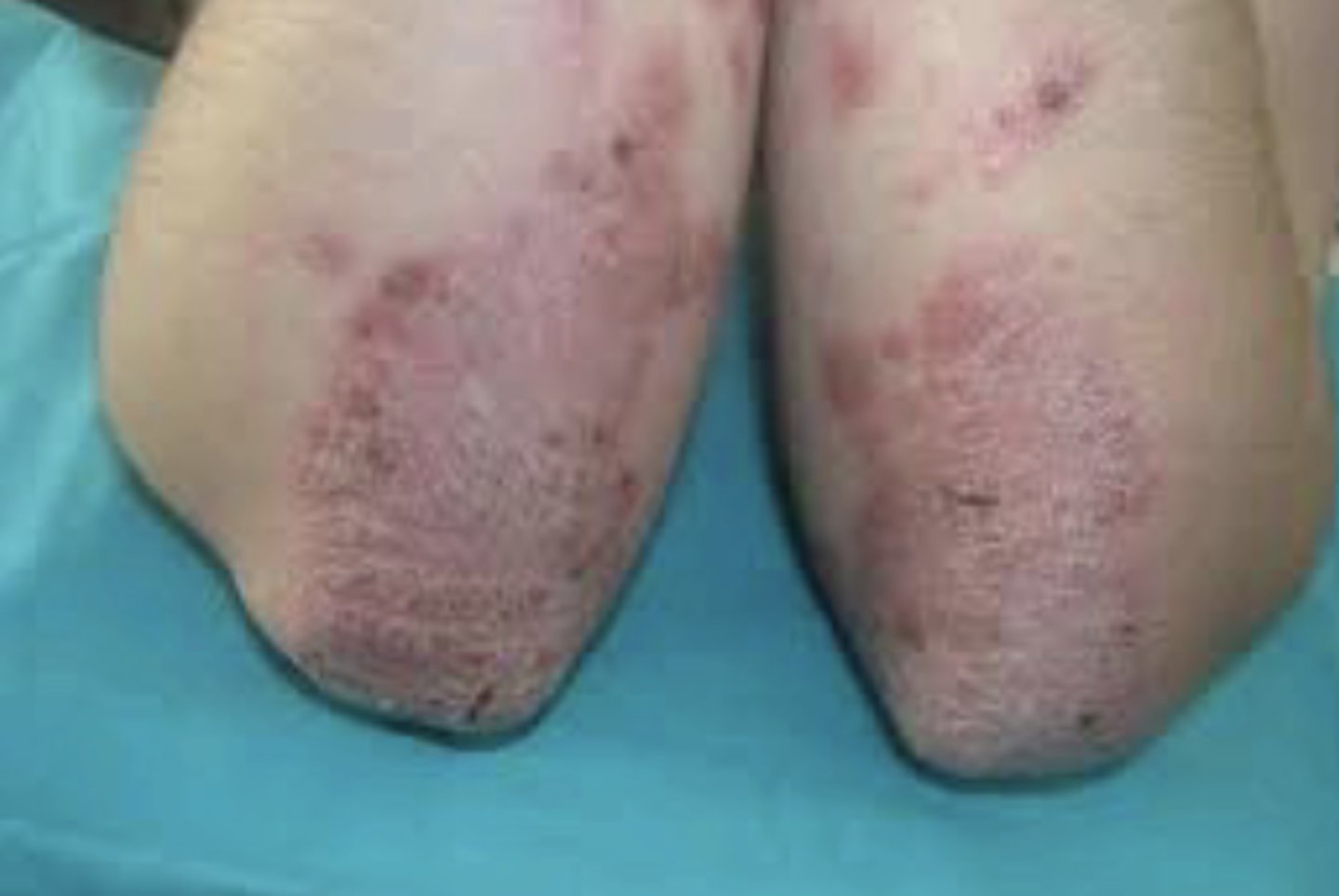 <p>A raised, palpable growth greater than 1.0 cm in size</p><p>*Number and location are keys to diagnosis</p>