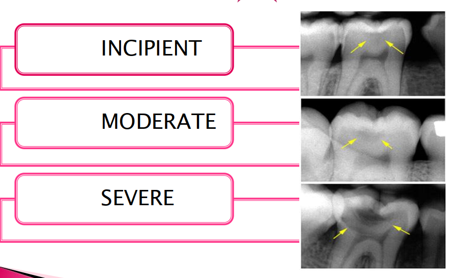 <ol><li><p>Incipient → cannot be seen on radiograph; <strong>only detected clinically</strong>; use explorer </p></li><li><p>Moderate → thin radiolucent line in dentin;<strong> located under enamel of occlusal surface</strong>; little radiographic changes noted in enamel; <strong>spreads laterally</strong> extending downward towards pulp once DEJ involved  </p></li><li><p>Severe → large radiolucency extending through enamel and dentin beyond DEJ; clinically appears as hole or cavity in tooth </p></li></ol><p></p>
