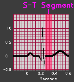 <p><strong>ST Segment</strong></p><p>-Represents early ___________</p><p>-Usually ____, AKA isoelectric</p><p>-Important in exercise testing, for it indicates oxygenation</p>