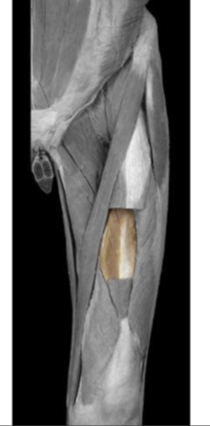 <p>Vastus intermedius </p>