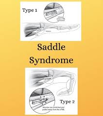 <ul><li><p>Differential diagnosis in Zones 4, 5, &amp; 6</p></li><li><p>Results in stiffness to MCPs and can look like they are unable to extend</p><ul><li><p><span>Common causes of this injury include crush injuries, a contusion from a direct blow, a fall on an outstretched hand, and torquing stresses</span></p></li></ul></li><li><p>Two different types: both cases it involves a deep transverse metacarpal ligament on volar surface of MCP joints</p><ul><li><p>Lumbricals and volar interossei split like scissors and deep transverse MCP ligament rides between the split</p><ul><li><p>If <strong><em>lumbricals and volar interossie adhere to each other and not the dTML</em></strong>, when attempting intrinsic <strong>plus position</strong>, with <strong><em>proximal excursion </em></strong>of lumbricals and Volar interossei, the dTML ‘splits’ the adhesion, resulting in pain</p></li><li><p>If <strong><em>lumbricals adhere to volar interossei AND the dTML </em></strong>with<strong><em> distal excursion</em></strong>, there is pain with <strong>intrinsic minus</strong> position as the adhesion pulls away from dTML</p></li></ul></li></ul></li></ul><p></p>