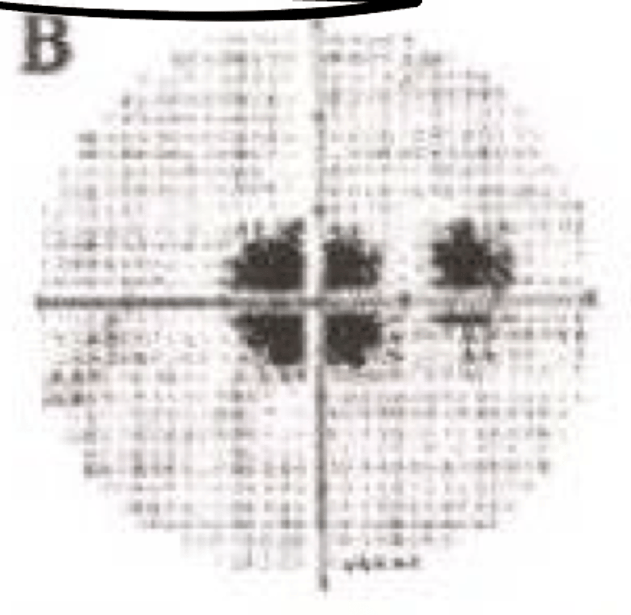 <p>What type of monocular pre-chiasmic VF defect is present in the given image?</p>