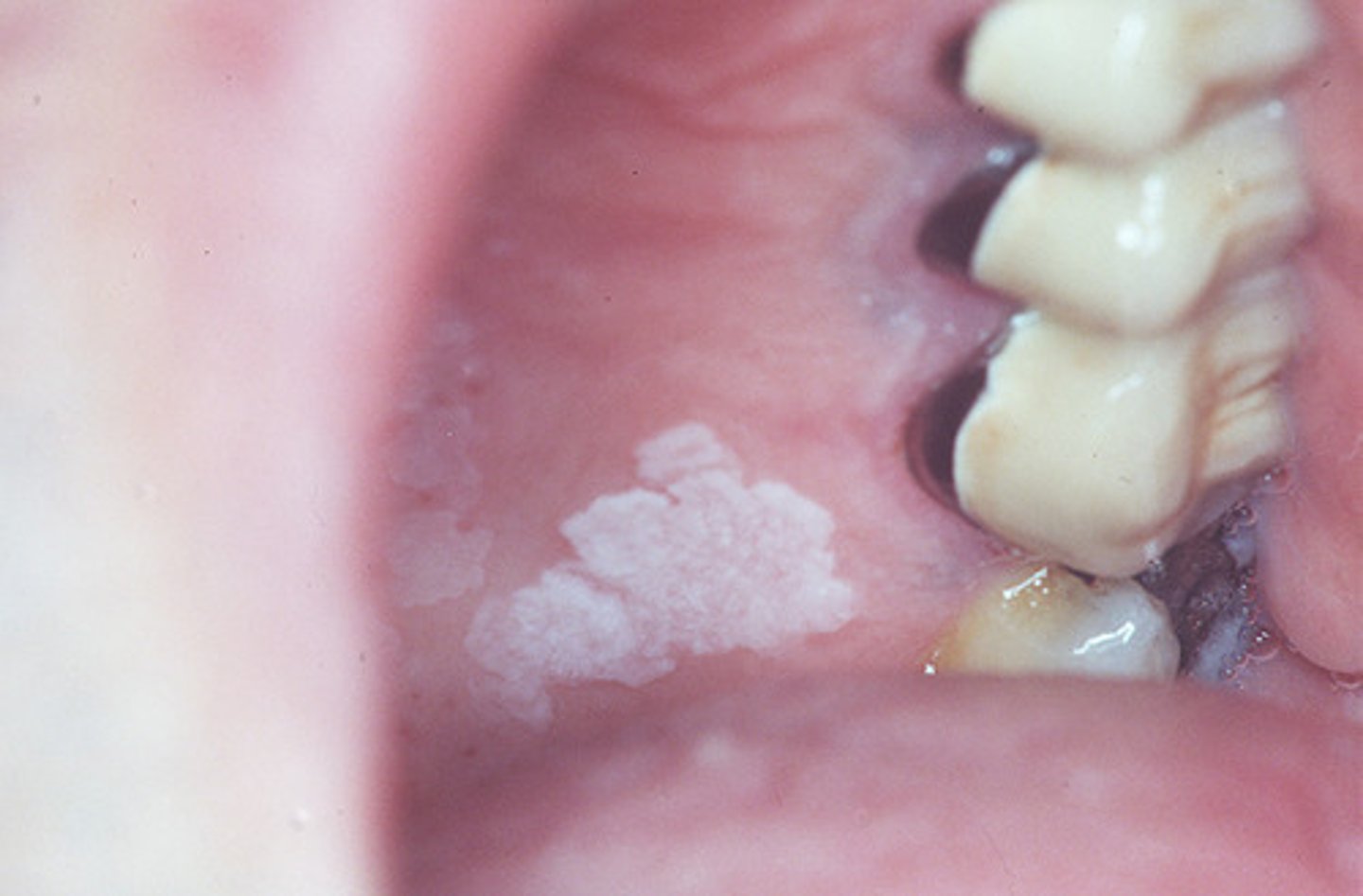 <p>persistent, adherent white plaque of the oral mucosa that cannot be rubbed off; results from a disturbance of surface epithelium</p><p>most are idiopathic, 2-6% are early SCC</p><p>increases risk of esophageal SCC</p>