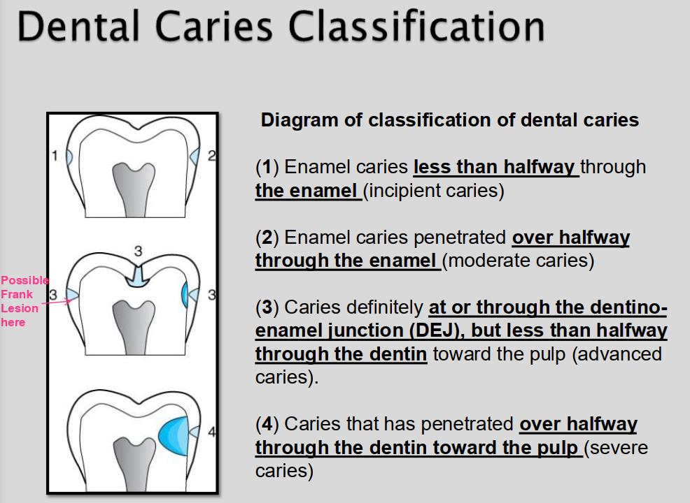 <ol><li><p>Class 1 = Incipient → beginning stages; small; only seen on enamel; tiny radiolucent notch; <strong>extends less than halfway through enamel thickness</strong></p></li><li><p>Class 2 = Moderate →<strong> extends more than halfway through enamel thickness but NOT involving DEJ;</strong> evident only on enamel; radiolucent triangle&nbsp;</p></li><li><p>Class 3 = Advanced → <strong>extends INTO or THROUGH DEJ but not more than half way through dentin towards pulp.; </strong>affecting enamel and dentin</p></li><li><p>Class 4 = Severe → <strong>extends THROUGH enamel and dentin and more than half the distance to pulp </strong></p></li></ol><p>** NOT THE SAME AS BLACKS CLASSIFICATION.</p><p></p>
