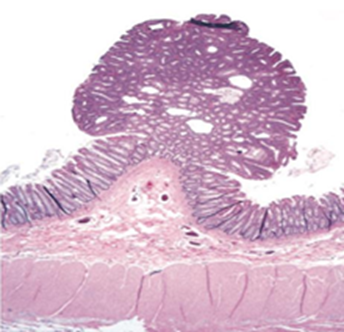 <p><strong><span>Describa la lesión, e identifique si corresponde a una neoplasia benigna o maligna y explique por qué</span></strong></p>