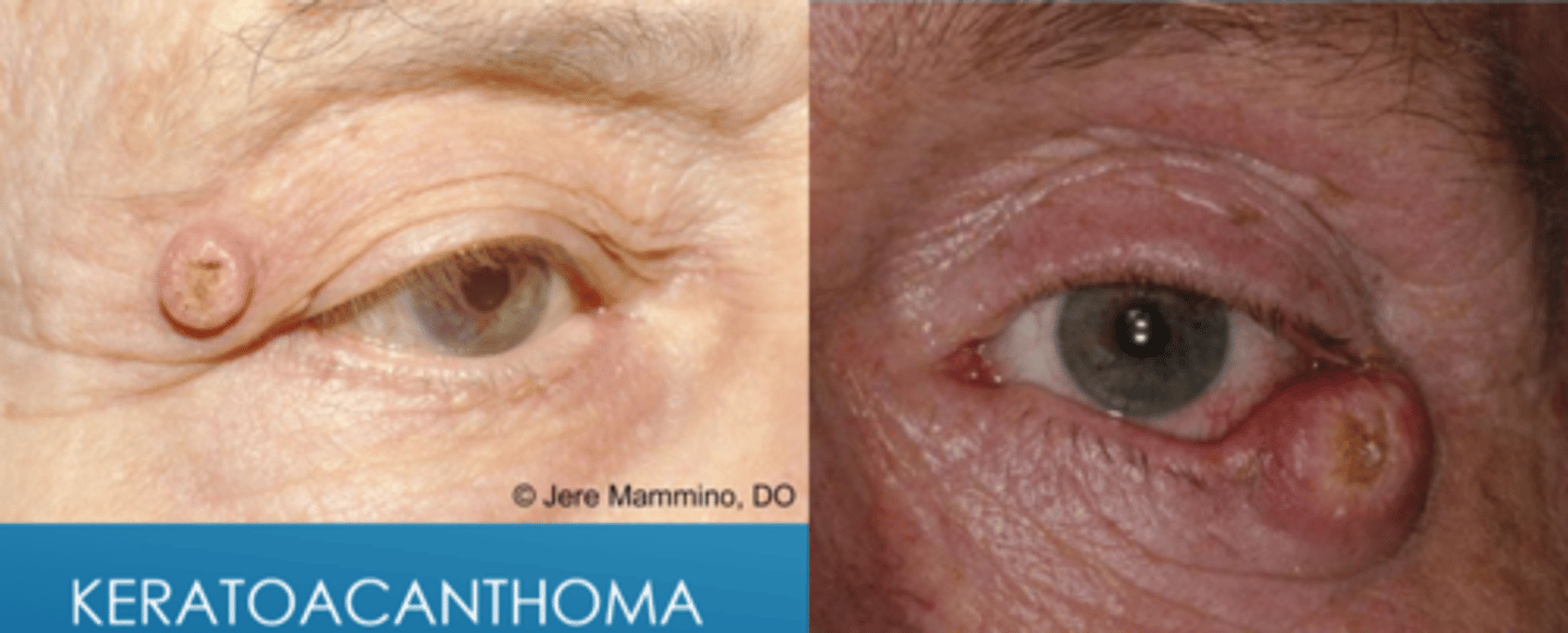 <p>conservative monitoring for changes </p><p>excision with blade or RF</p><p>chemotherapy with 5-FU, methotrexate</p><p>refer for oculoplastics if concern for malignancy</p>