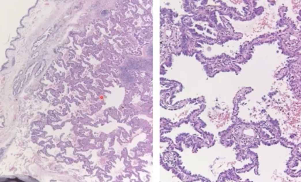 The histology of an adenocarcinoma in the lungs looks like this, how do it look on the organ itself ? What category of carcinoma does it fall under? 