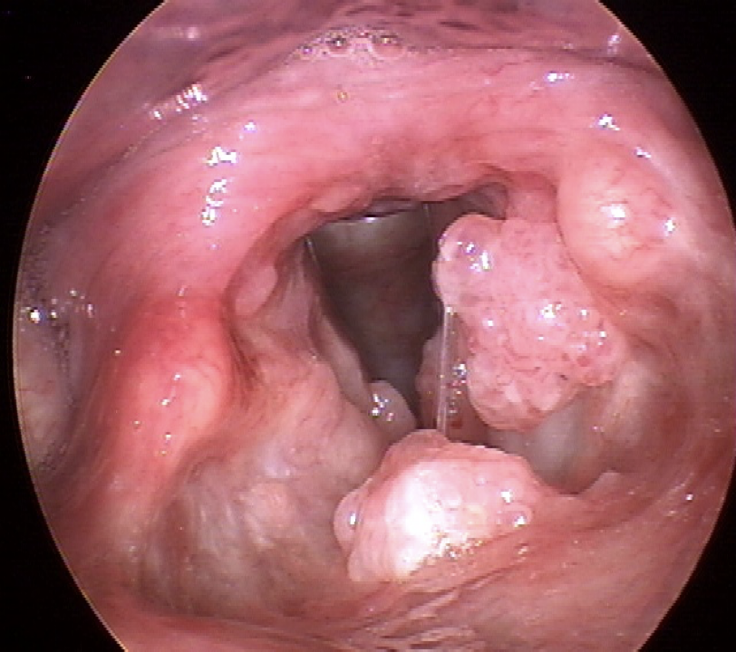 Bilateral papillomas on the vocal cords