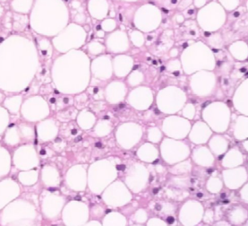 <p>Hepatic lipidosis</p><p>Top = focal - tension lipidosis in a horse</p><p>Bottom = zonal - chronic passive congestion in a cow</p>