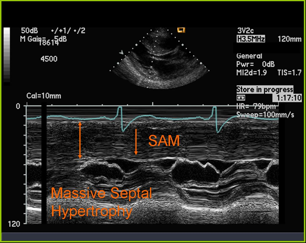 <p>Systolic anterior motion of MV</p><p>HOCM</p>