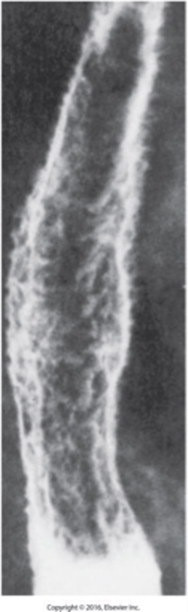 <p>What is esophagitis due to infection called?</p>