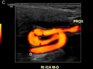 <p>What kind of limitation to a carotid exam is seen here? </p>