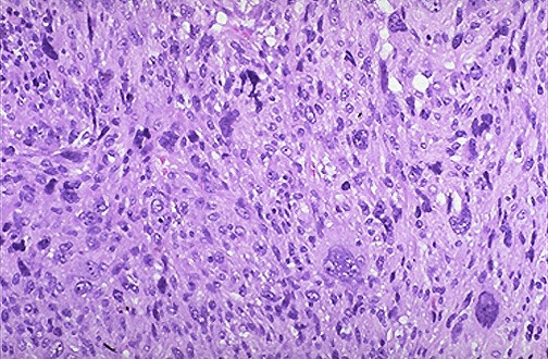 <ol><li><p>Cellular morphology of sarcoma</p></li><li><p>Nuclear feature of sarcoma cells</p></li><li><p>Differentiation status of sarcoma cells</p></li></ol><p></p>