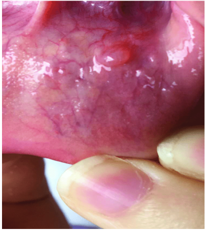 <p>What lesion is this?</p>