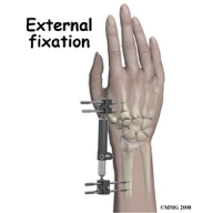 <p>pins going into person’s bones, used if pt has infection in area </p><p>the frankenstein things </p>