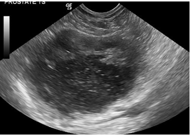 <p>Cyst or abscess?</p>