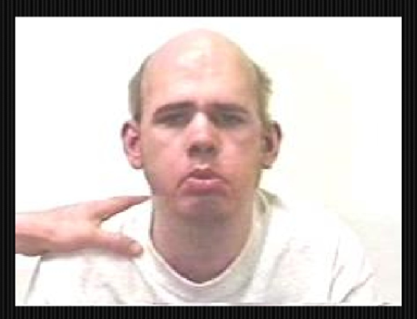 <p>toupee/hair loss w/ bilateral optic neuritis = syphillis </p><p>receded hair line w/ hatchet-shaped face, myotonic eyelids = myotonic dystrophy</p>
