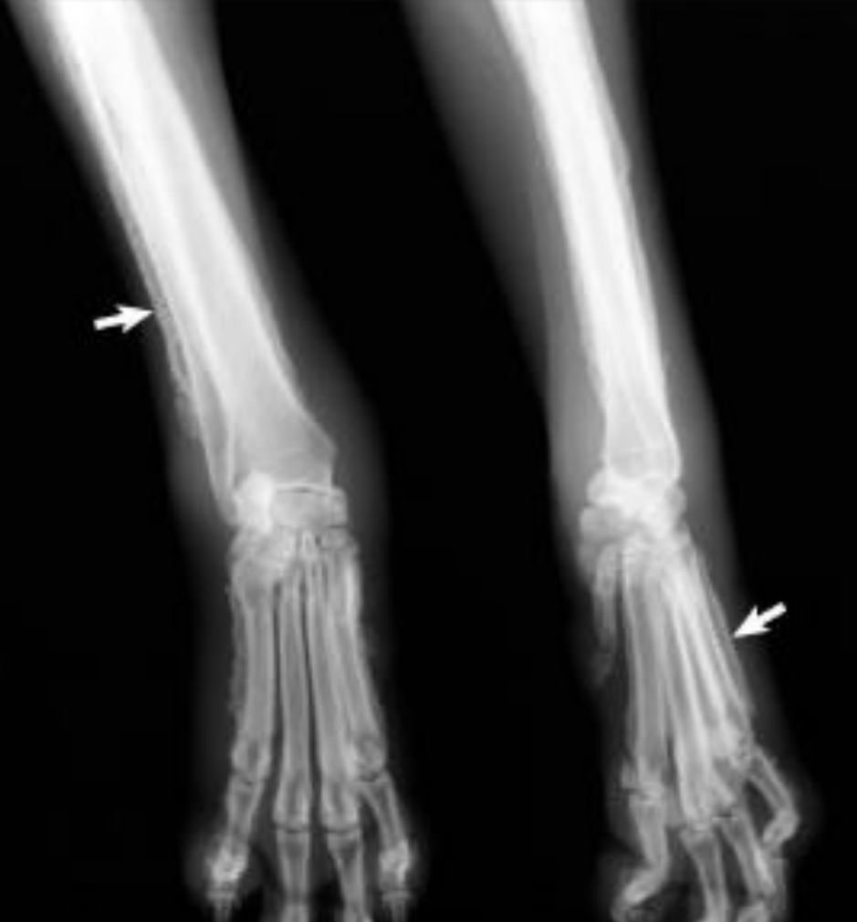 <p>Hypertrophic osteopathy is?</p>