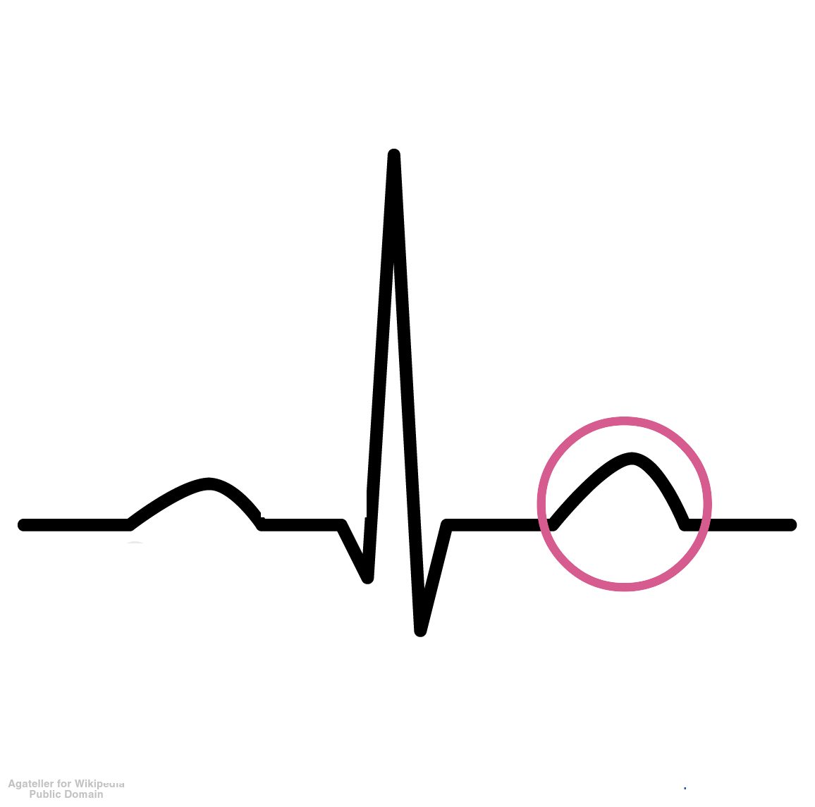 <p>Represents ventricular repolarization; a wave that follows the QRS complex.</p>