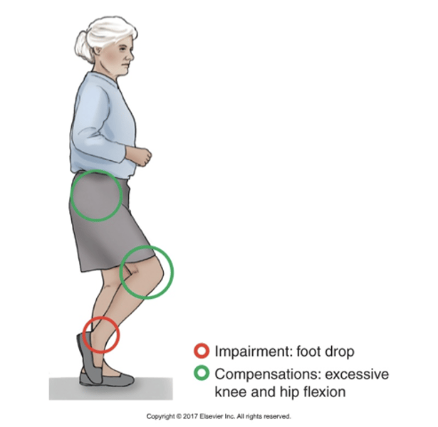 <p>-Excessive Hip and Knee Flexion to Compensate for Foot Drop<br><br>-Weak ankle dorsiflexion may result in foot drop during swing phase requiring excessive knee and hip flexion for the toes to clear the ground as the limb is advanced</p>